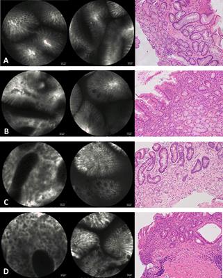 Confocal Laser Endomicroscopy Can Improve the Diagnosis Rate and Range Assessment of Patients With Conflicting <mark class="highlighted">Chronic Atrophic Gastritis</mark> Results of White Light Endoscopic and Pathological Diagnosis